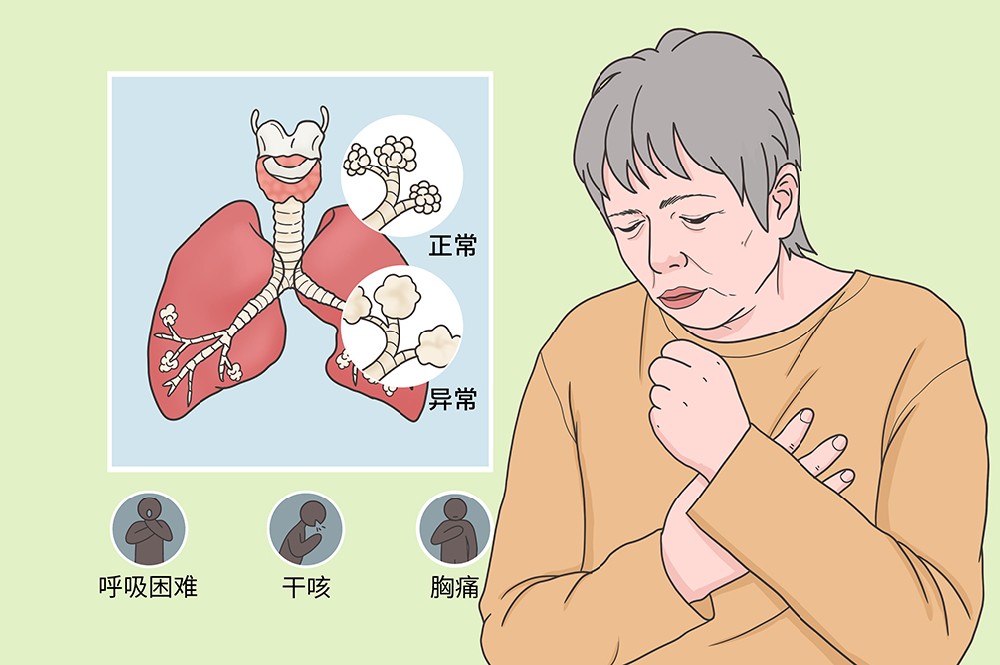 间质性肺炎.jpg