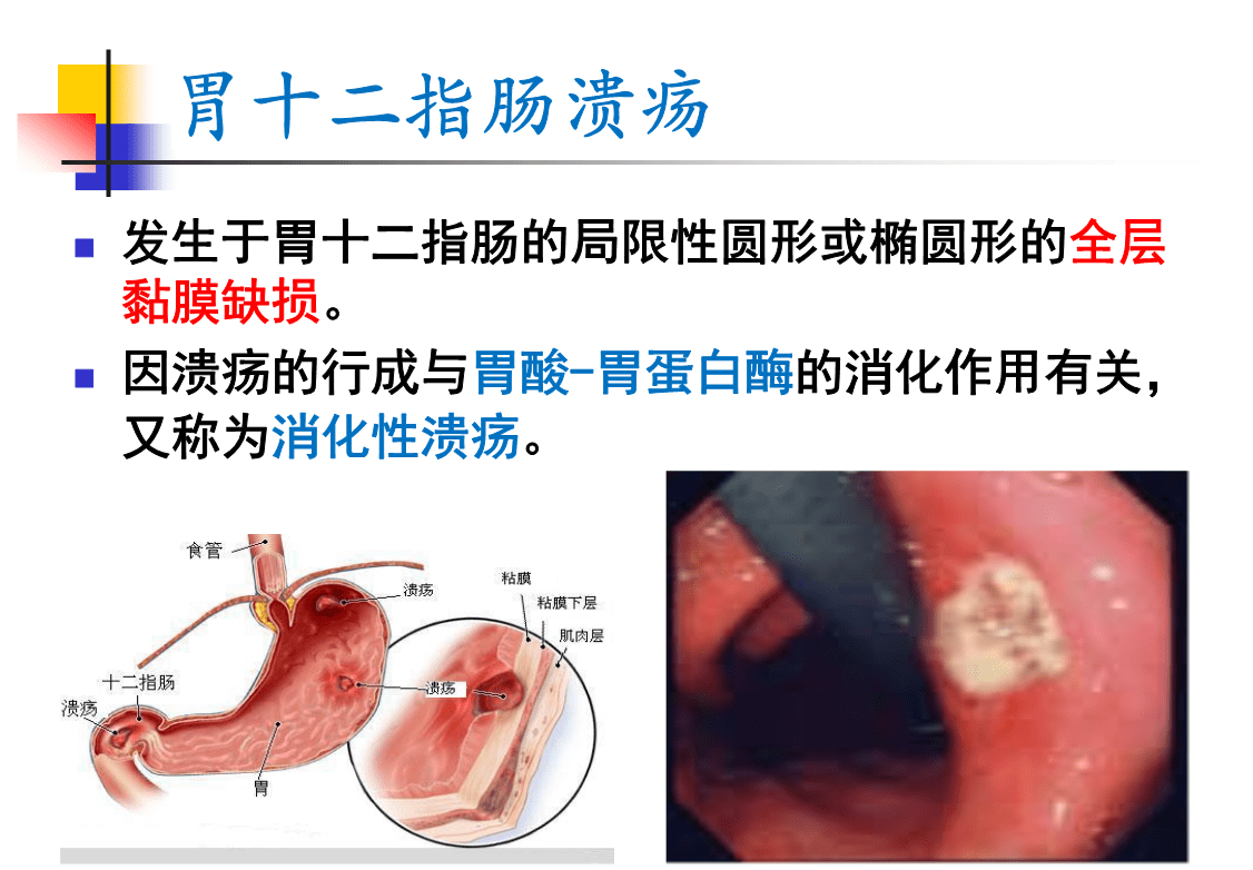 十二指肠溃疡.png