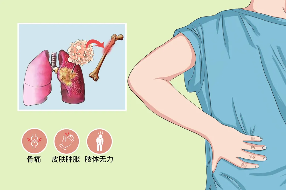肺癌.png