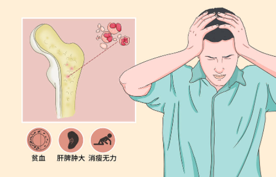 骨髓纤维化.png